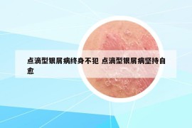 點(diǎn)滴型銀屑病終身不犯 點(diǎn)滴型銀屑病堅(jiān)持自愈