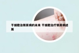 干細(xì)胞治銀屑病的未來 干細(xì)胞治療銀屑病進(jìn)展