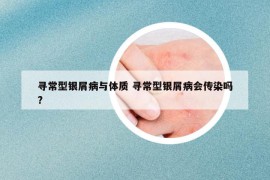 尋常型銀屑病與體質(zhì) 尋常型銀屑病會傳染嗎?