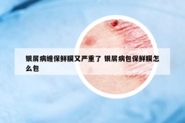 銀屑病纏保鮮膜又嚴重了 銀屑病包保鮮膜怎么包