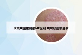 大斑塊副銀屑病MF區(qū)別 斑塊狀副銀屑病