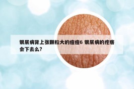 銀屑病背上張顆粒大的痘痘6 銀屑病的疙瘩會(huì)下去么?