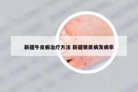 新疆牛皮癬治療方法 新疆銀屑病發(fā)病率
