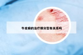 牛皮癬的治療跟分型有關系嗎