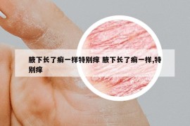 腋下長(zhǎng)了癬一樣特別癢 腋下長(zhǎng)了癬一樣,特別癢