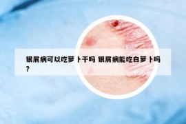 銀屑病可以吃蘿卜干嗎 銀屑病能吃白蘿卜嗎?