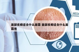 面部皮癬適合什么面霜 面部皮癬適合什么面霜用