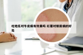 吃地瓜對(duì)牛皮癬有效果嗎 紅薯對(duì)銀屑病的好處