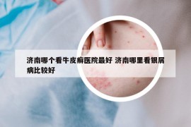 濟(jì)南哪個看牛皮癬醫(yī)院最好 濟(jì)南哪里看銀屑病比較好