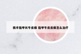 我手指甲長(zhǎng)牛皮癬 指甲牛皮皮癬怎么治療