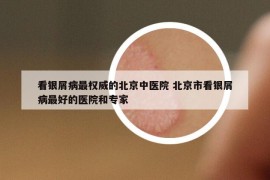 看銀屑病最權(quán)威的北京中醫(yī)院 北京市看銀屑病最好的醫(yī)院和專家