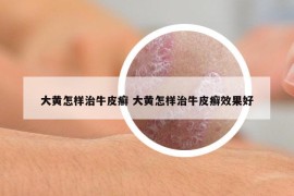 大黃怎樣治牛皮癬 大黃怎樣治牛皮癬效果好