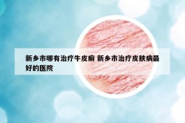 新鄉(xiāng)市哪有治療牛皮癬 新鄉(xiāng)市治療皮膚病最好的醫(yī)院