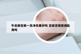 牛皮癬百癬一洗凈效果好嗎 百蘚膏銀屑病能用嗎