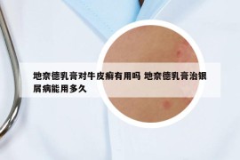 地奈德乳膏對牛皮癬有用嗎 地奈德乳膏治銀屑病能用多久
