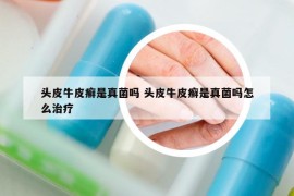 頭皮牛皮癬是真菌嗎 頭皮牛皮癬是真菌嗎怎么治療