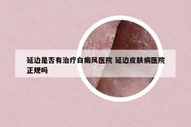 延邊是否有治療白癜風(fēng)醫(yī)院 延邊皮膚病醫(yī)院正規(guī)嗎