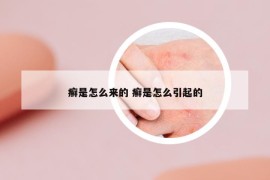 癬是怎么來的 癬是怎么引起的
