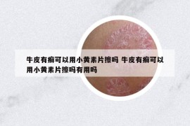 牛皮有癬可以用小黃素片擦嗎 牛皮有癬可以用小黃素片擦嗎有用嗎