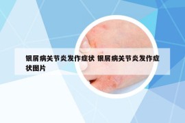 銀屑病關(guān)節(jié)炎發(fā)作癥狀 銀屑病關(guān)節(jié)炎發(fā)作癥狀圖片