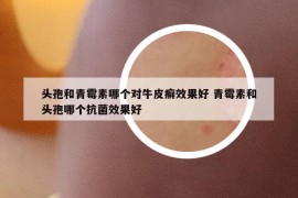 頭孢和青霉素哪個對牛皮癬效果好 青霉素和頭孢哪個抗菌效果好