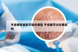 牛皮癬患者能不能吃香菇 牛皮廨可以吃香菇嗎