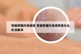 蕁麻疹圖片和癥狀 蕁麻疹圖片和癥狀有什么辦法解決