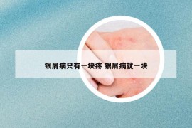 銀屑病只有一塊疼 銀屑病就一塊