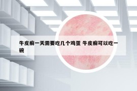 牛皮癬一天需要吃幾個雞蛋 牛皮癬可以吃一碗