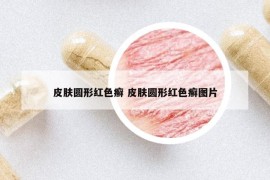 皮膚圓形紅色癬 皮膚圓形紅色癬圖片