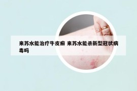 來蘇水能治療牛皮癬 來蘇水能殺新型冠狀病毒嗎