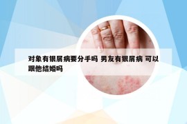 對(duì)象有銀屑病要分手嗎 男友有銀屑病 可以跟他結(jié)婚嗎