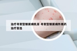 治療尋常型銀屑病乳膏 尋常型銀屑病外用藥治療首選