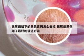 銀屑病留下的黑色素斑怎么去掉 銀屑病黑色印子最好的消退方法