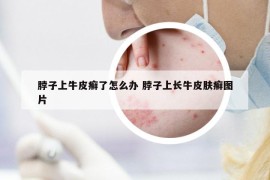 脖子上牛皮癬了怎么辦 脖子上長牛皮膚癬圖片