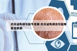 內(nèi)分泌失調(diào)引起牛皮癬 內(nèi)分泌失調(diào)會(huì)引起哪些皮膚病