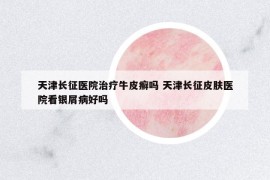 天津長(zhǎng)征醫(yī)院治療牛皮癬嗎 天津長(zhǎng)征皮膚醫(yī)院看銀屑病好嗎