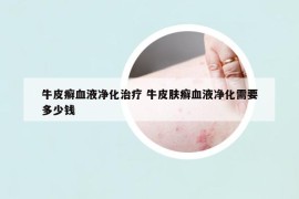 牛皮癬血液凈化治療 牛皮膚癬血液凈化需要多少錢