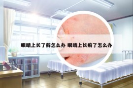 眼睛上長了蘚怎么辦 眼睛上長癬了怎么辦
