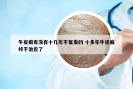 牛皮癬有沒(méi)有十幾年不復(fù)發(fā)的 十多年牛皮癬終于治愈了