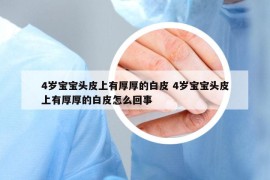 4歲寶寶頭皮上有厚厚的白皮 4歲寶寶頭皮上有厚厚的白皮怎么回事