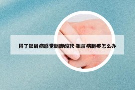 得了銀屑病感覺腿腳酸軟 銀屑病腿疼怎么辦