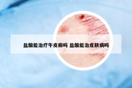 鹽酸能治療牛皮癬嗎 鹽酸能治皮膚病嗎