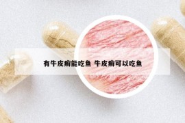 有牛皮癬能吃魚 牛皮癬可以吃魚