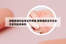 副銀屑病引起骨關(guān)節(jié)疼痛 銀屑病性關(guān)節(jié)炎會(huì)不會(huì)引起骨損傷