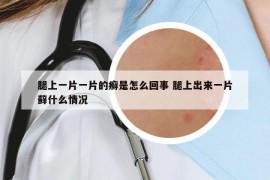 腿上一片一片的癬是怎么回事 腿上出來(lái)一片蘚什么情況
