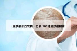 皮膚病忌口發(fā)物一覽表 100種皮膚病照片