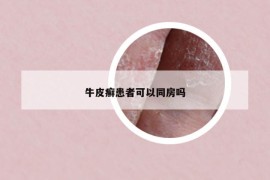 牛皮癬患者可以同房嗎