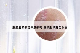 胳膊肘長(zhǎng)癬是牛皮癬嗎 胳膊肘長(zhǎng)蘚怎么治