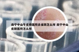 南寧中山牛皮癬醫(yī)院去雀斑怎么樣 南寧中山皮膚醫(yī)院怎么樣
